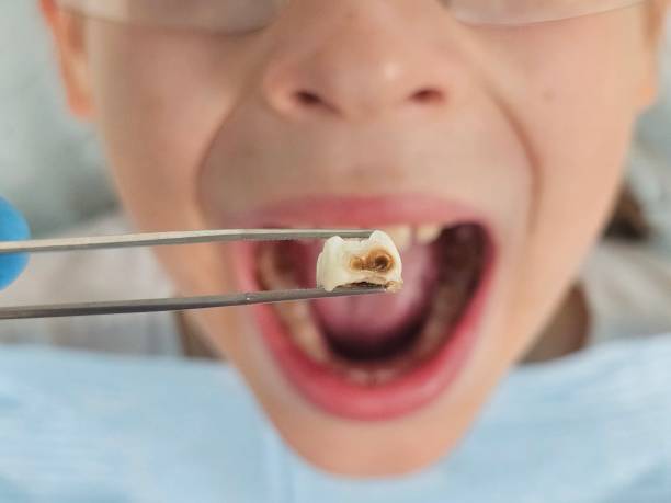 Best Dentist for Tooth Abscess  in Fiskdale, MA